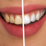 Warum sind ältere Erwachsene anfälliger für Zahnverfärbungen?